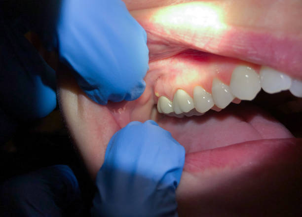 Best Teeth Whitening  in Malden, MO